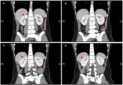 A Case Report and Literature Review of Mesalazine-Induced Kidney Injury in a Pediatric Patient With Ulcerative Colitis